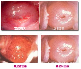 宫颈肥大