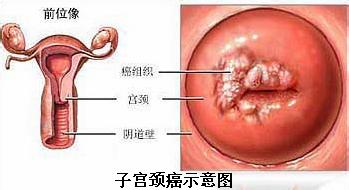 子宫颈疾病2.jpg