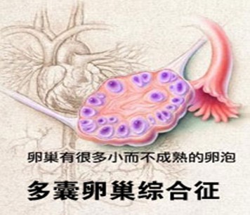 多囊卵巢综合症